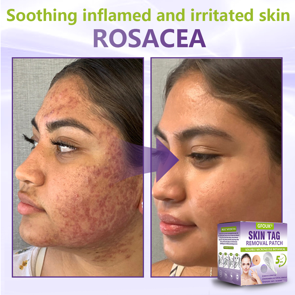 GFOUK® Soluble Microneedle Botanical Skin Tag Removal Patch🎉🎉