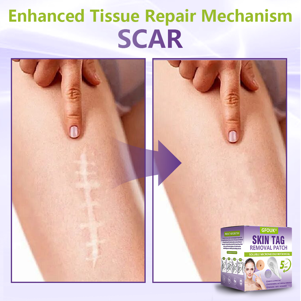 GFOUK® Soluble Microneedle Botanical Skin Tag Removal Patch🎉🎉