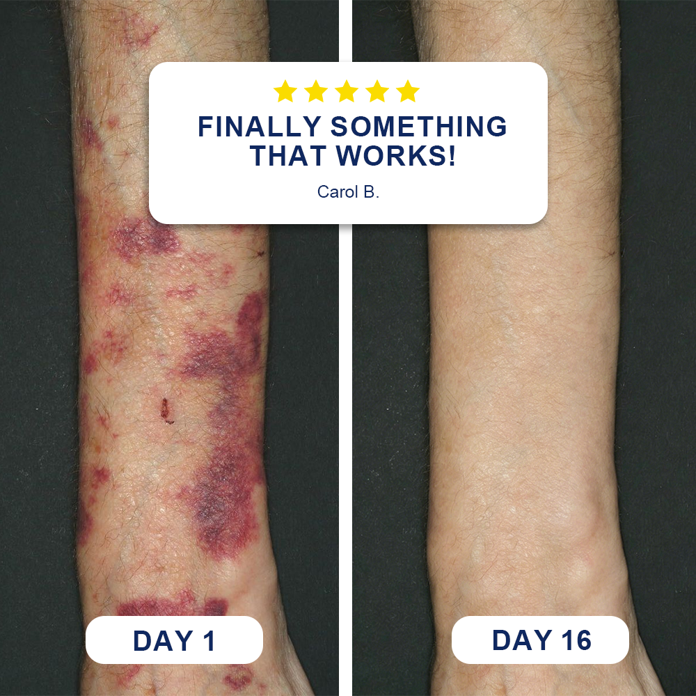 ✨Evolvion® Bruise Repair & Skin-Strengthening Cream🍀