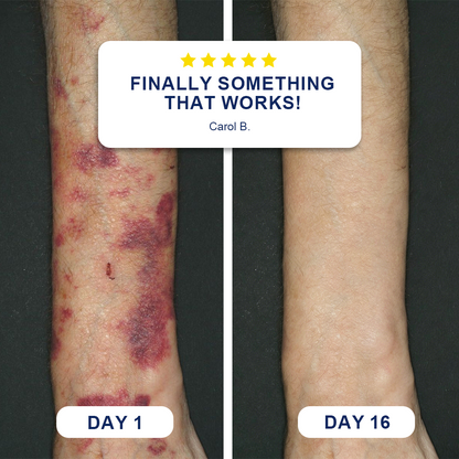 ✨Evolvion® Bruise Repair & Skin-Strengthening Cream🍀