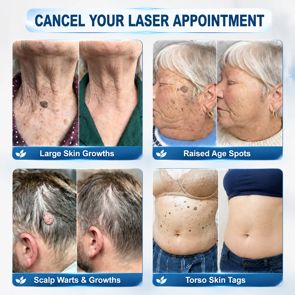 ✨Evolvion® 𝟕-𝐃𝒂𝘆 𝐒𝗸𝐢𝐧 𝐓𝒂𝗴 & 𝐒𝐩𝙤𝐭 𝐄𝐫𝒂𝐬𝙚𝐫 Painless & Scar-Free Advanced Imperfection Remova𝗜 Ro𝗜𝗜erba𝗜𝗜 Pen-up