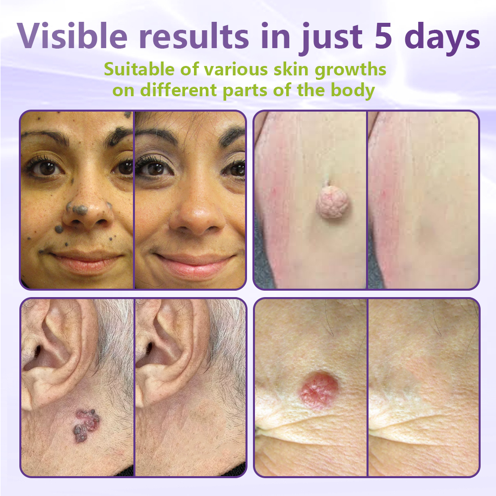 GFOUK® Soluble Microneedle Botanical Skin Tag Removal Patch🎉🎉