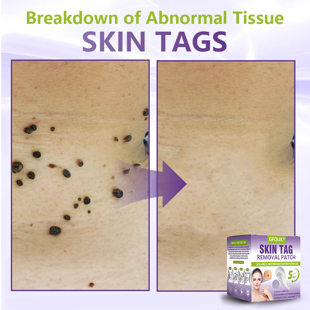 GFOUK® Soluble Microneedle Botanical Skin Tag Removal Patch🎉🎉