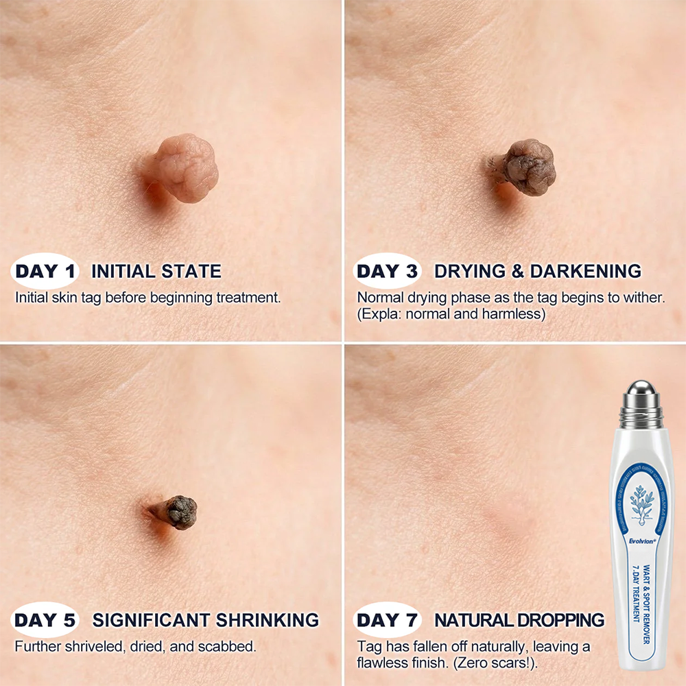 ✨Evolvion® 𝟕-𝐃𝒂𝘆 𝐒𝗸𝐢𝐧 𝐓𝒂𝗴 & 𝐒𝐩𝙤𝐭 𝐄𝐫𝒂𝐬𝙚𝐫 Painless & Scar-Free Advanced Imperfection Remova𝗜 Ro𝗜𝗜erba𝗜𝗜 Pen-up