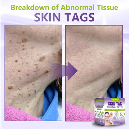 GFOUK® Soluble Microneedle Botanical Skin Tag Removal Patch🎉🎉