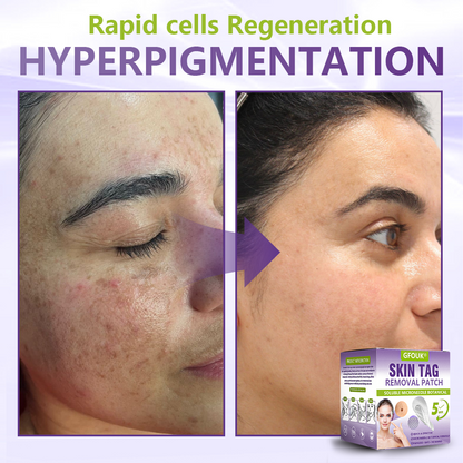 GFOUK® Soluble Microneedle Botanical Skin Tag Removal Patch🎉🎉