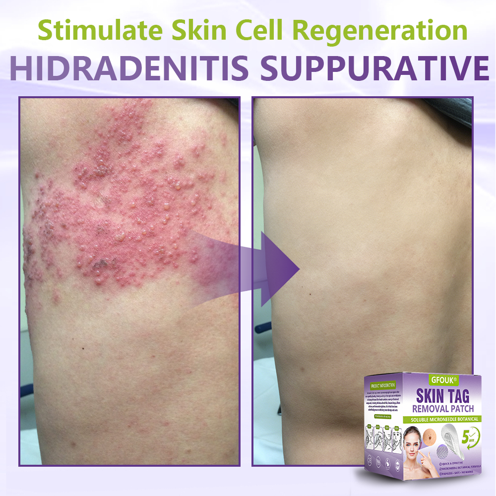GFOUK® Soluble Microneedle Botanical Skin Tag Removal Patch🎉🎉