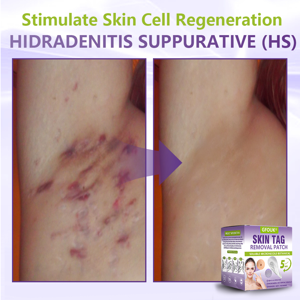 GFOUK® Soluble Microneedle Botanical Skin Tag Removal Patch🎉🎉